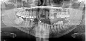 dental x-ray top and bottom